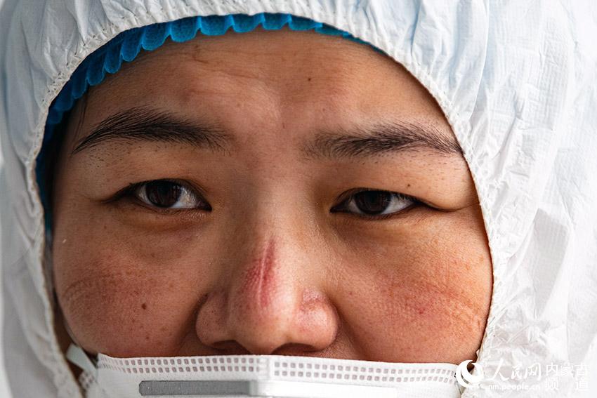 日前，在阿魯科爾沁旗同濟醫院的發熱門診，醫護人員由於長時間工作，臉上留下了口罩護目鏡深深的印痕。張棖 李忠慧攝影報道
